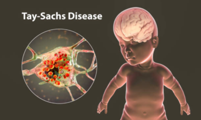7 Common Inherited Diseases in Nigeria