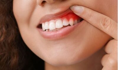 Natural Remedies To Cure Mouth Fever