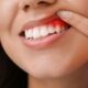 Natural Remedies To Cure Mouth Fever